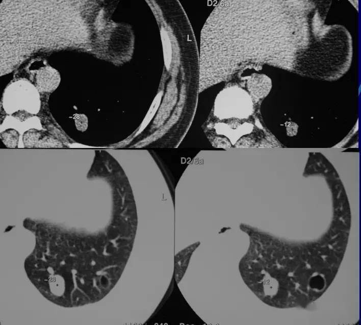 肺小结节影像诊断