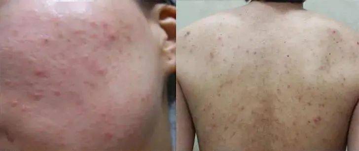 背后有痘印怎么刷酸 00b3405b690e467db978bd09288b98d8.jpeg