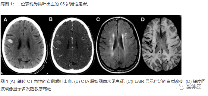 脑淀粉样血管病影像学特点 皮质