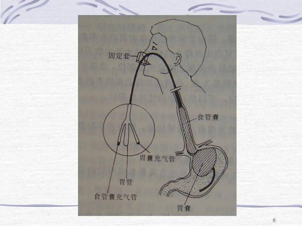 三腔二囊管的应用及护理