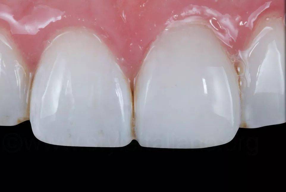 牙医学堂单颗牙树脂贴面直接修复