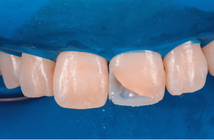 复合树脂微创美学修复——前牙的修复