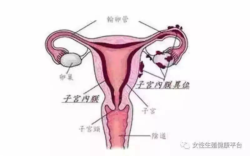 子宫腺肌症是什么病种 e9ba62548d264c99a692bb57b59cf2bf.jpeg