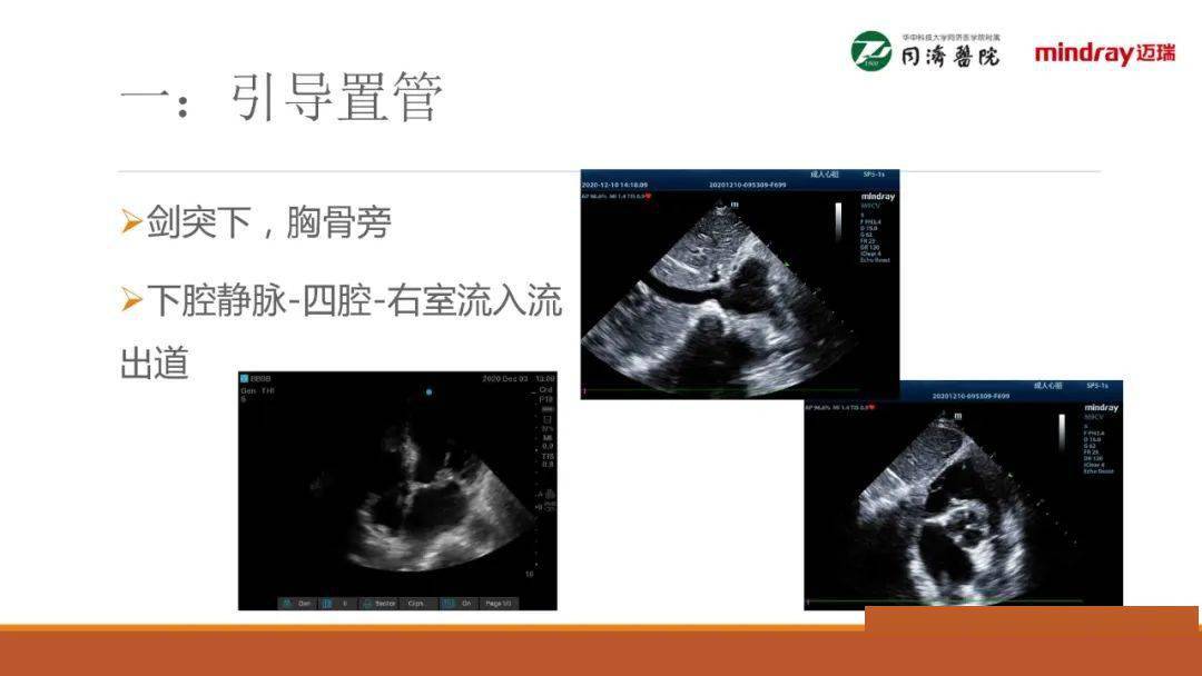 武汉同济医院麻醉科围术期经胸超声心动图tte