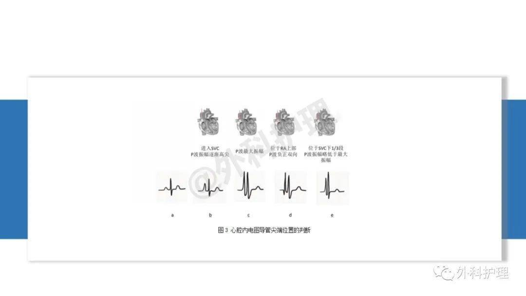 pptpicc尖端心腔內電圖定位技術中華護理學會團體標準