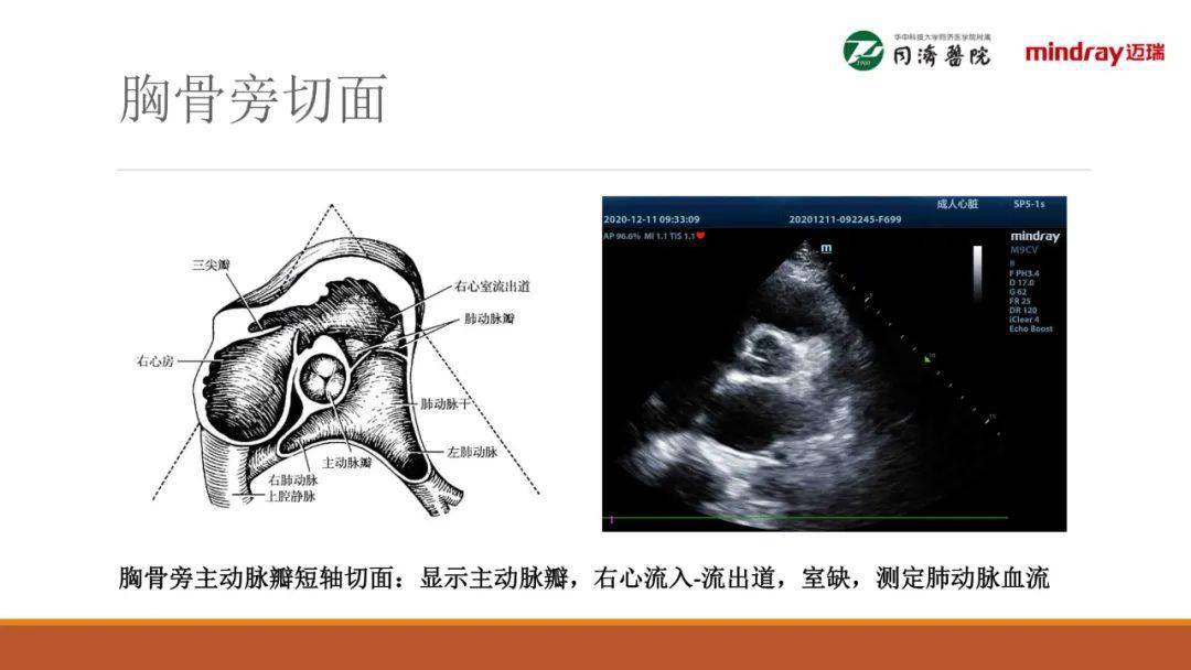 武汉同济医院麻醉科围术期经胸超声心动图tte