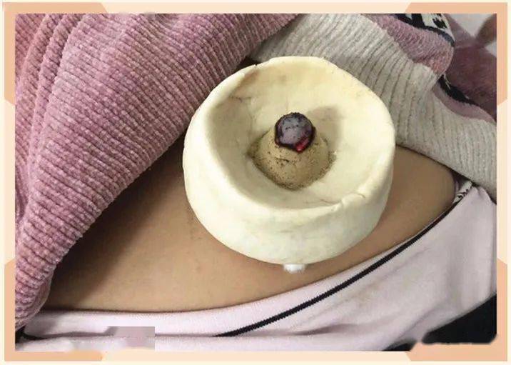 小儿脾胃虚夜惊尿床出汗多别着急不打针不吃药区中医院儿科脐疗有奇效