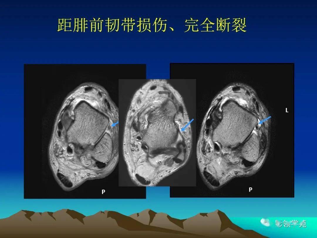 断裂的碎片远离骨折的位置并游离于关节腔踝关节外侧韧带急性损伤的