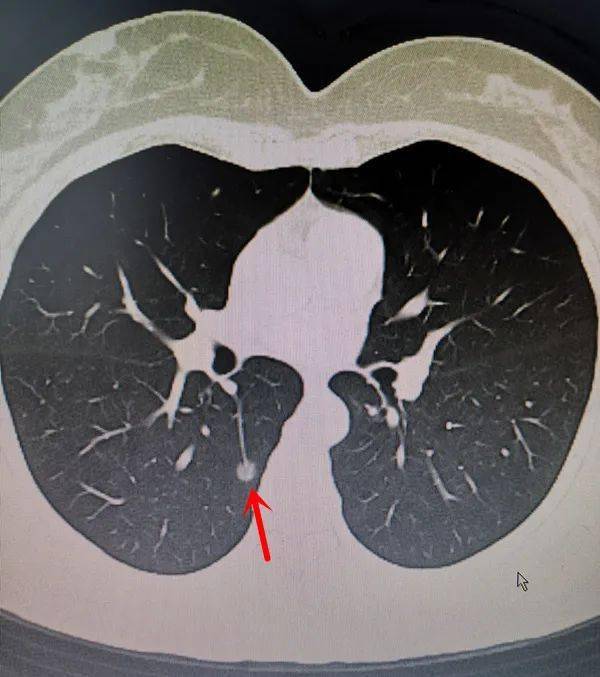 视频体检时发现肺部小结节该怎么办