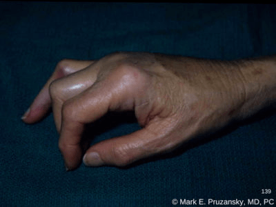 疼厦门一女子边切菜边闲聊菜刀剁掉指头肉