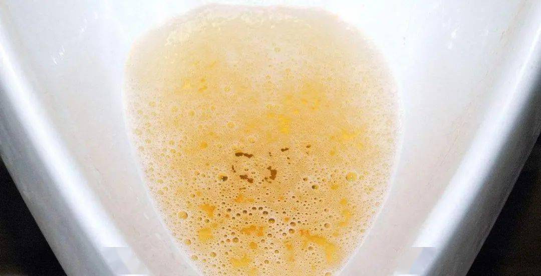 尿酸高后,晨起4个表现,说明已经连累到肾,请及时降尿酸