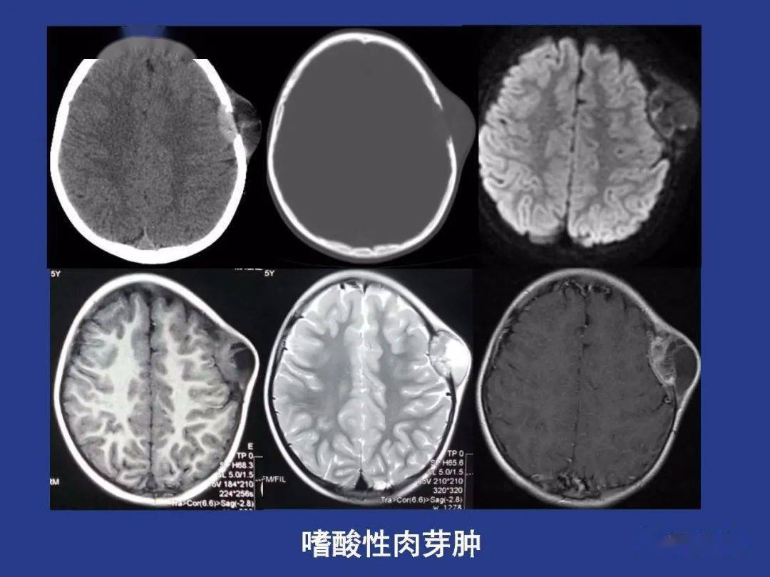 颅骨虫蚀样骨质破坏图片