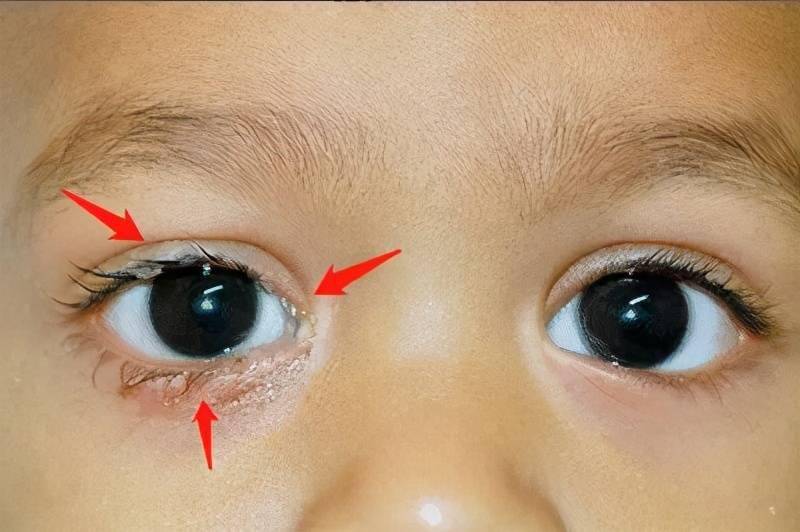如果宝宝眼泪以及眼屎偏多,颜色多是白色或浅黄的,白眼球正常,也没有