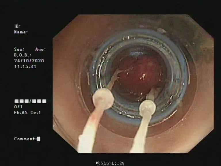 内镜下痔上直肠粘膜套扎术中照片消化内科主任张介琴(右)为痔疮患者
