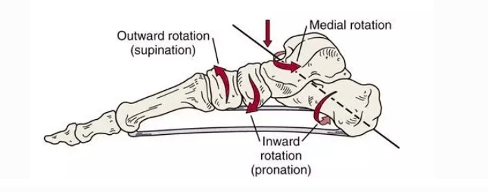 脛骨內轉產生足部的旋前(pronation),後足與中足向內旋轉(旋前)而前足