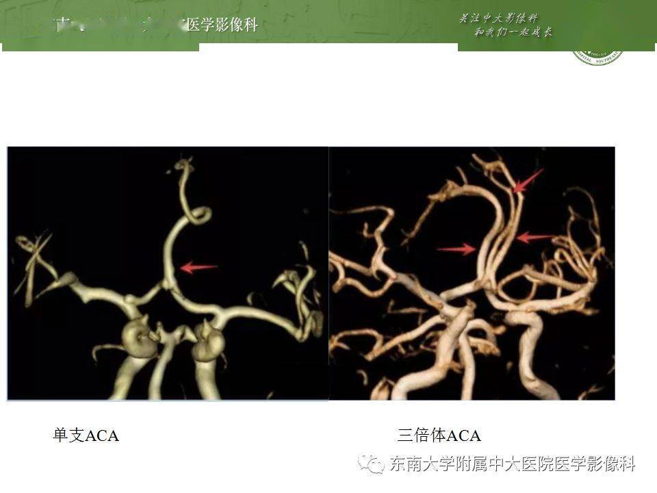 解剖| 頭部血管解剖及willis環常見變異