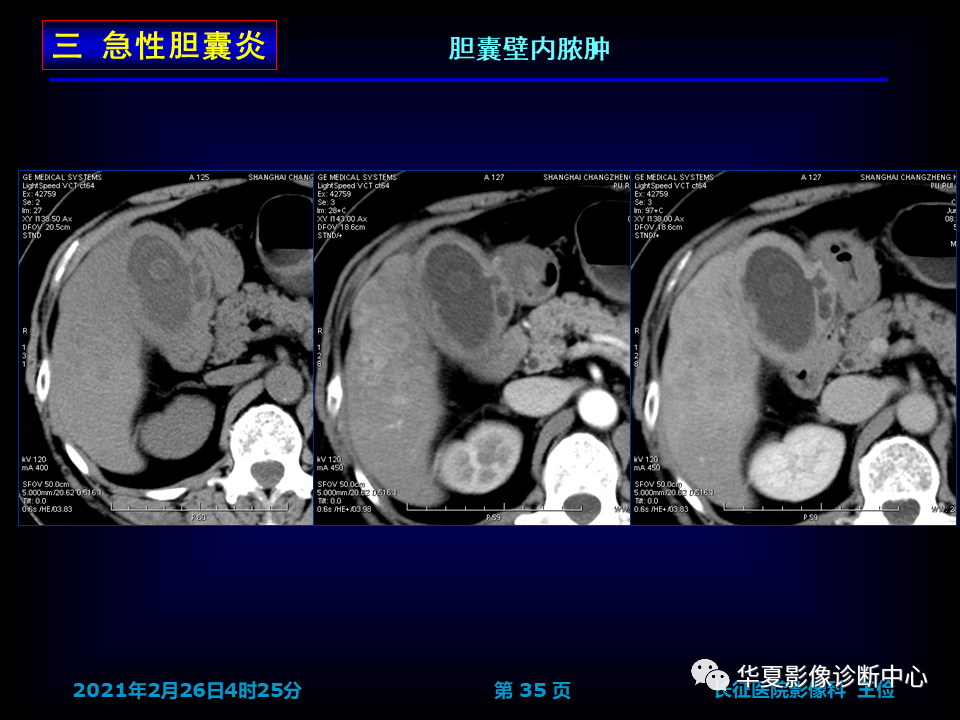 胆囊炎影像诊断