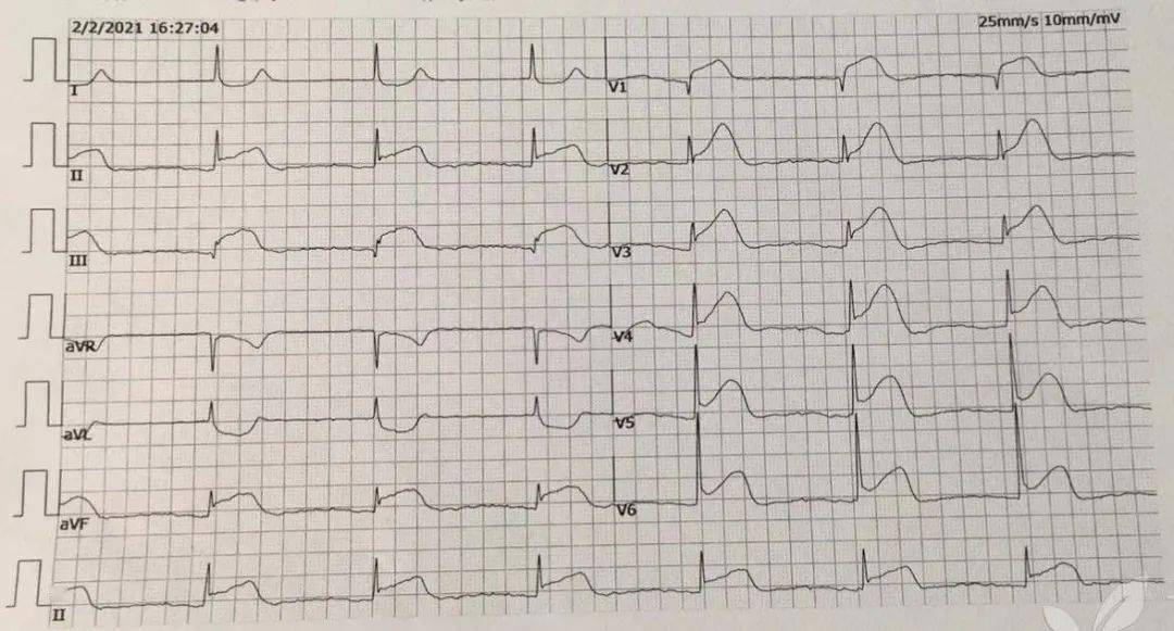 急性心梗   洋地黄中毒 | 达摩心电图专栏