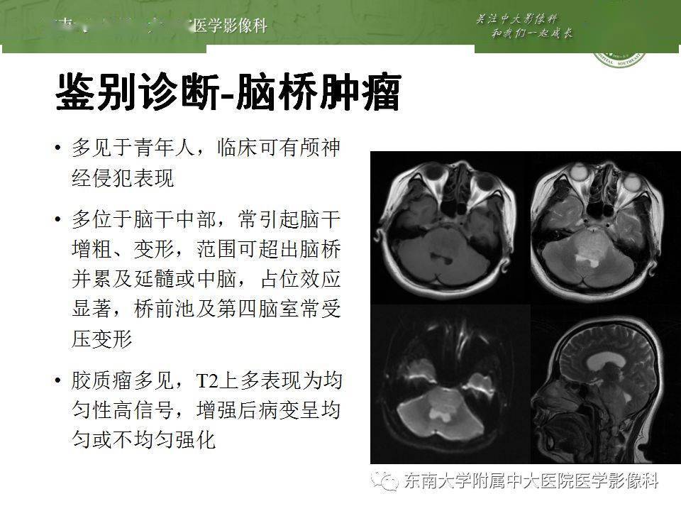 脑桥中央髓鞘溶解症影像表现