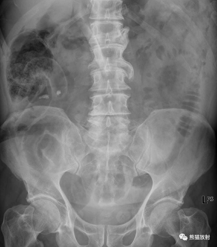 仰卧位腹部平片示右上腹肠壁的两侧见气体影,即rigler征.