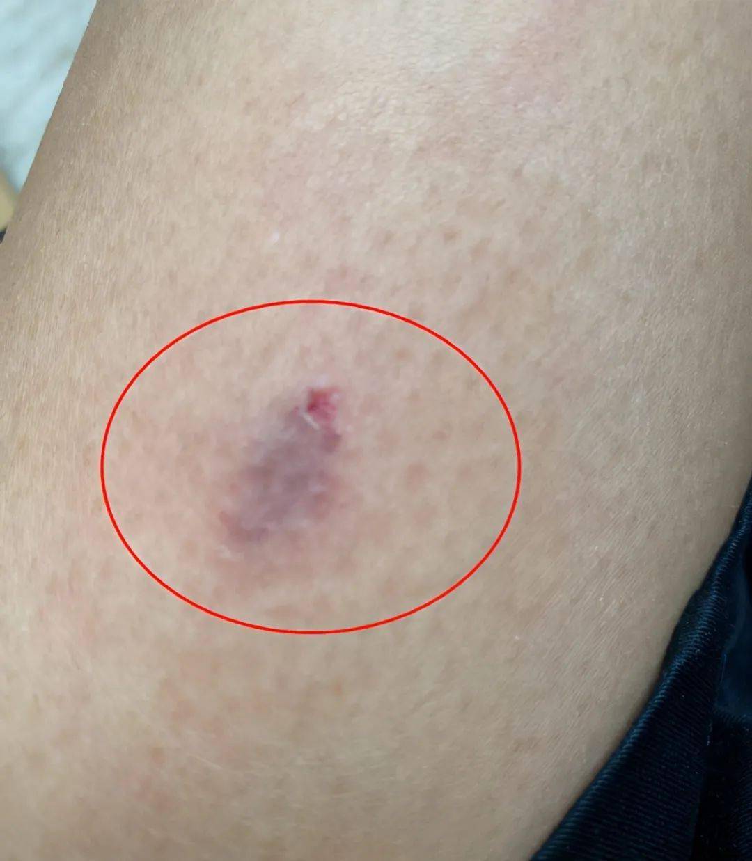 从蔡少芬晒出的这组照片可以看出,她的伤口处不仅有一大块淤青,还破了