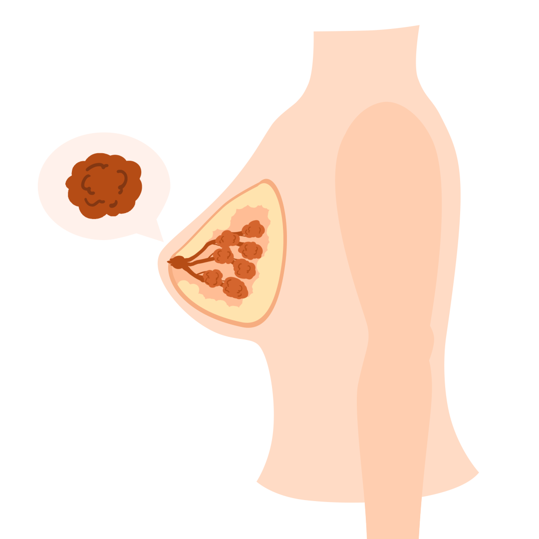 一女子患乳腺癌4个月后在东阳市人民医院坚强生下孩子