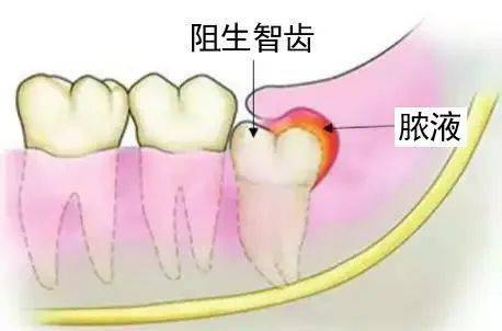 冲洗消炎,持续两三天后疼痛及炎症消失,再选择合适的时机进行智齿拔除