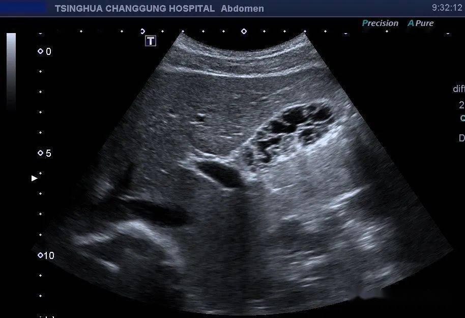 经典图片:蜂巢样胆囊_症状