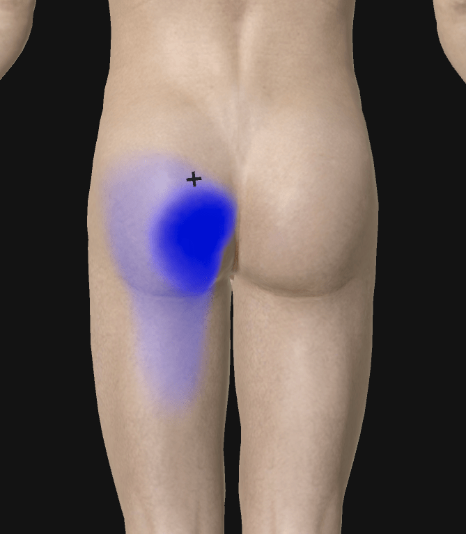 什么是坐骨神经痛腿疼 c2af73ac85704e029213950c0a99f309.png