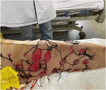 跨年战役团队协作战胜坏死性筋膜炎图片真实胆小慎入