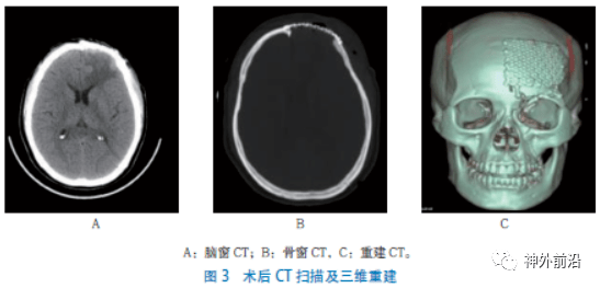 眉骨骨折图片ct图片