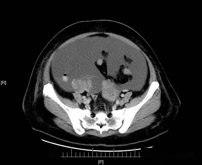 卵巢囊腺瘤CT图片