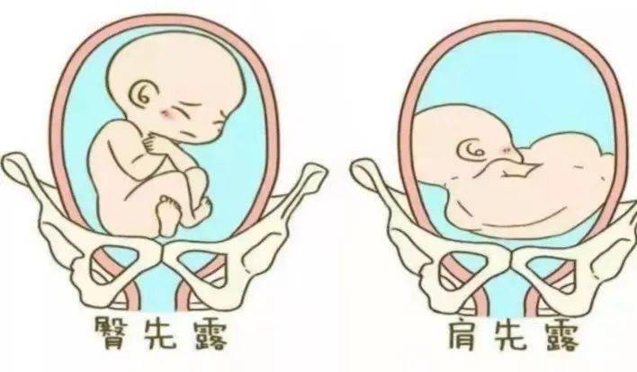 称为臀位,在妈妈肚子里出现胎位异常很多宝宝过于调皮可能连