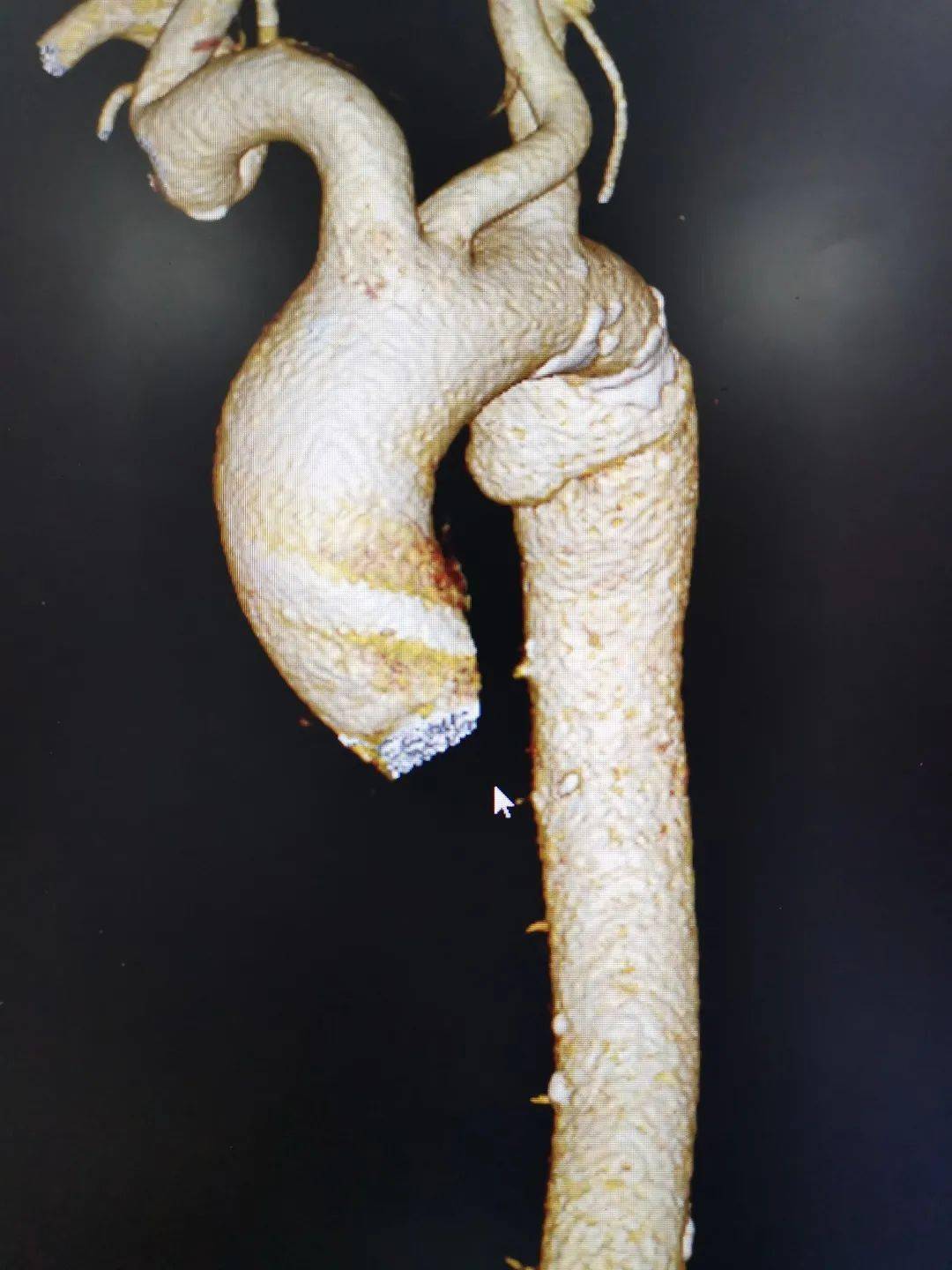 持续半小时的急性剧烈胸痛其症状与肋骨骨折引起的胸部疼痛不相符