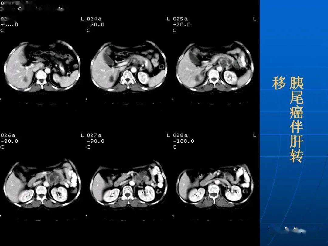 9种胰腺常见疾病的ct诊断