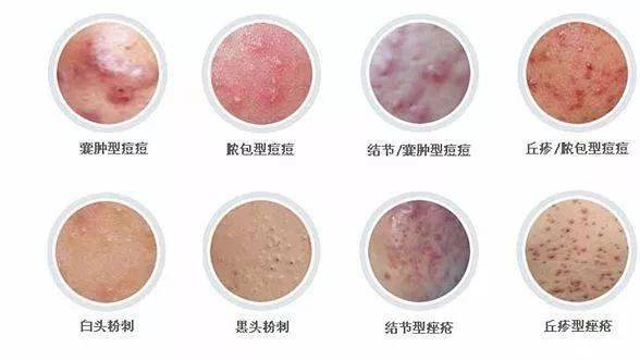 为啥前胸后背老长痘痘