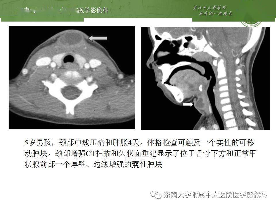 異位甲狀腺甲狀舌管囊腫影像表現