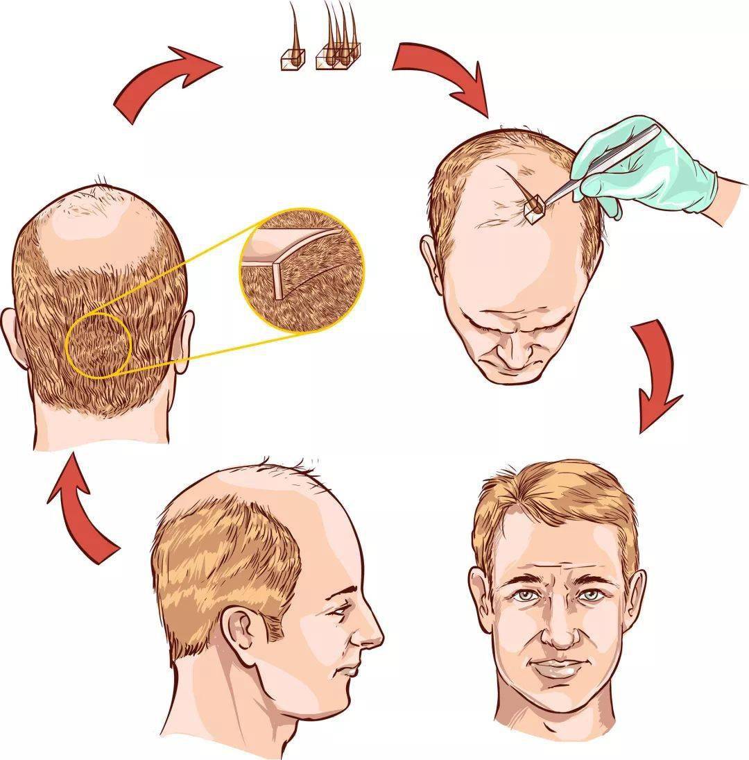 植发是属于一种自体毛囊移植的植发,是把自身后枕部的毛囊,通过培养