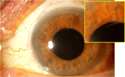 新生血管性青光眼:虹膜瞳孔边缘的新生血管,前房角新生血管,继发性房