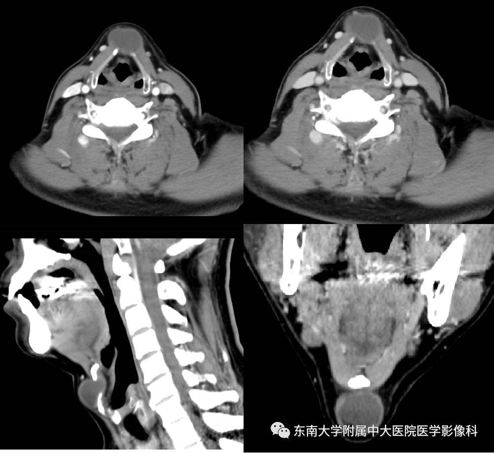 異位甲狀腺甲狀舌管囊腫影像表現