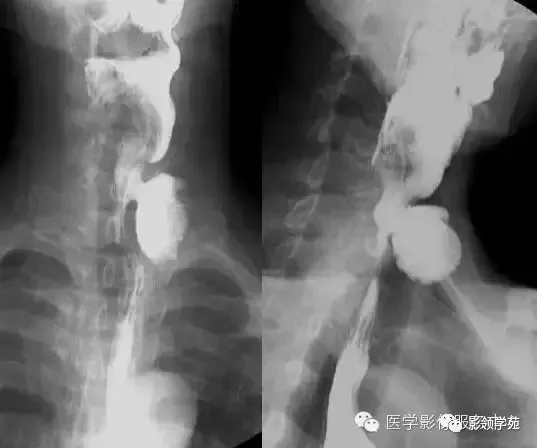 10种食管钡餐常见疾病图解