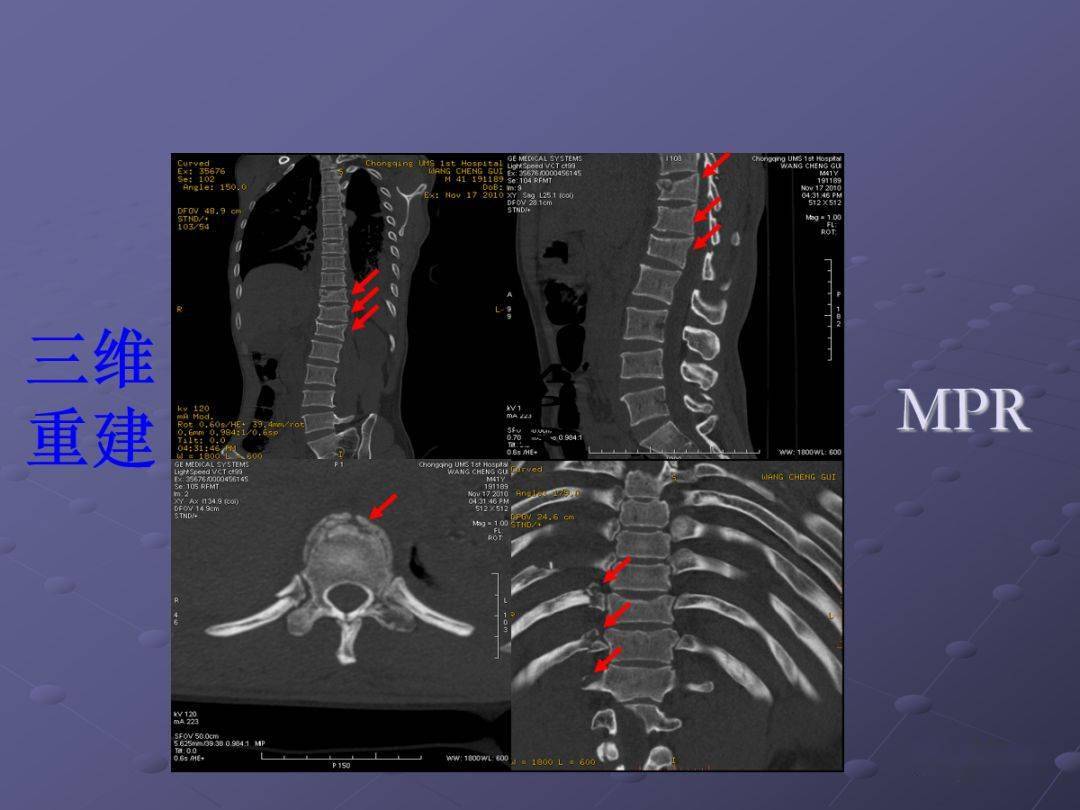 详解脊柱常见疾病的mri诊断技巧值得学习借鉴