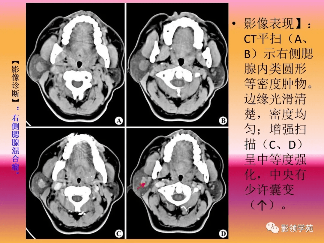 腮腺解剖结构图CT图片