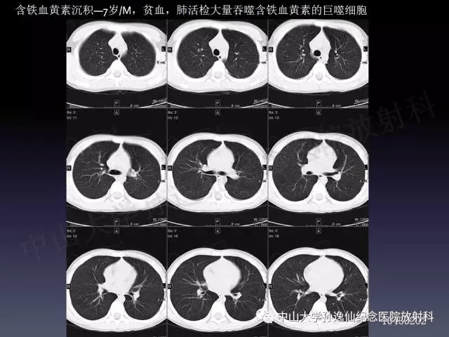 肺淤血ct表现图片图片