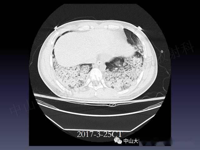 肺出血的影像学特征
