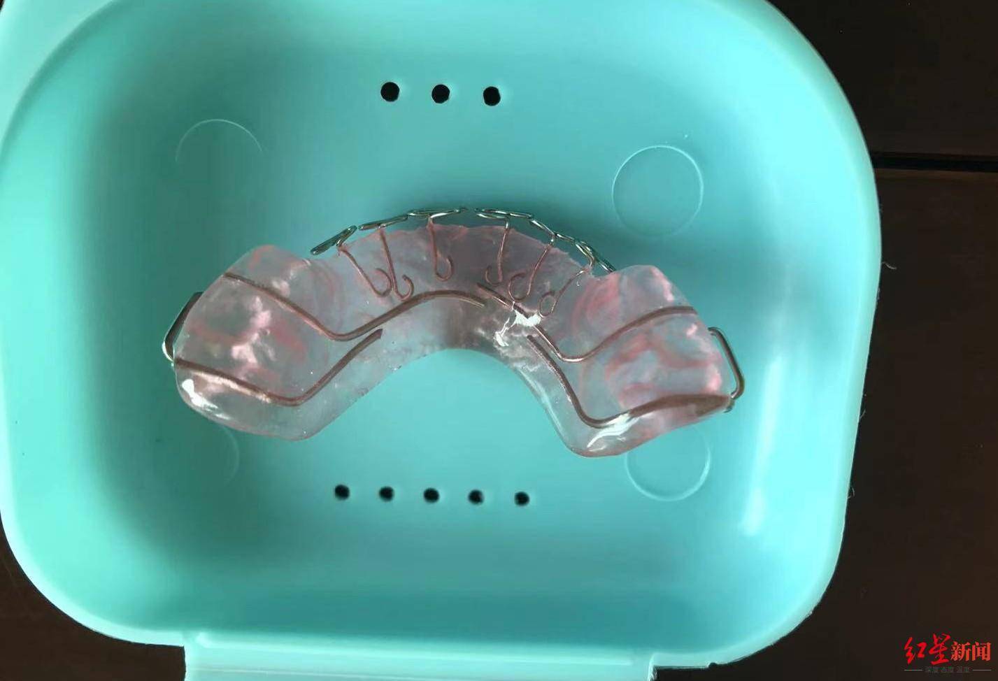 3岁男童误吞牙套致食道穿孔家长将其倒立没想到竟口吐鲜血