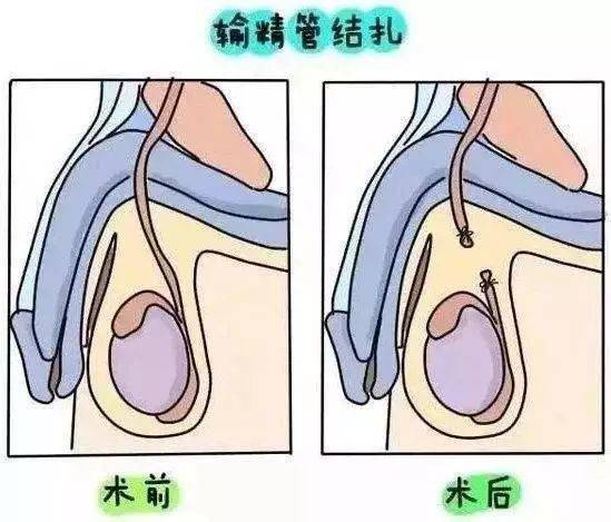 男性結紮還是女性結紮哪個更好是時候明確一下答案了