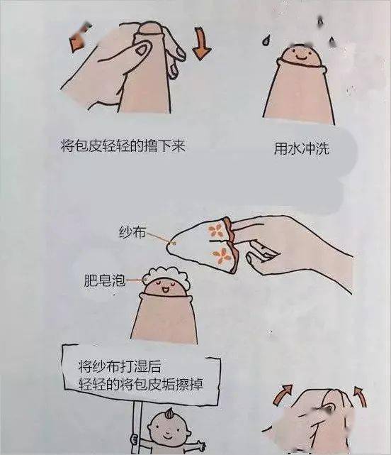 如何正确帮小孩翻包茎图片