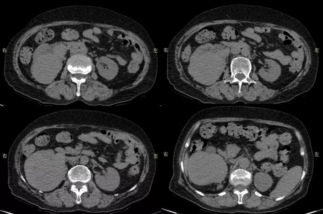 病例賞析 | 腰痛伴血尿,少見且典型的腎腫瘤請你來看