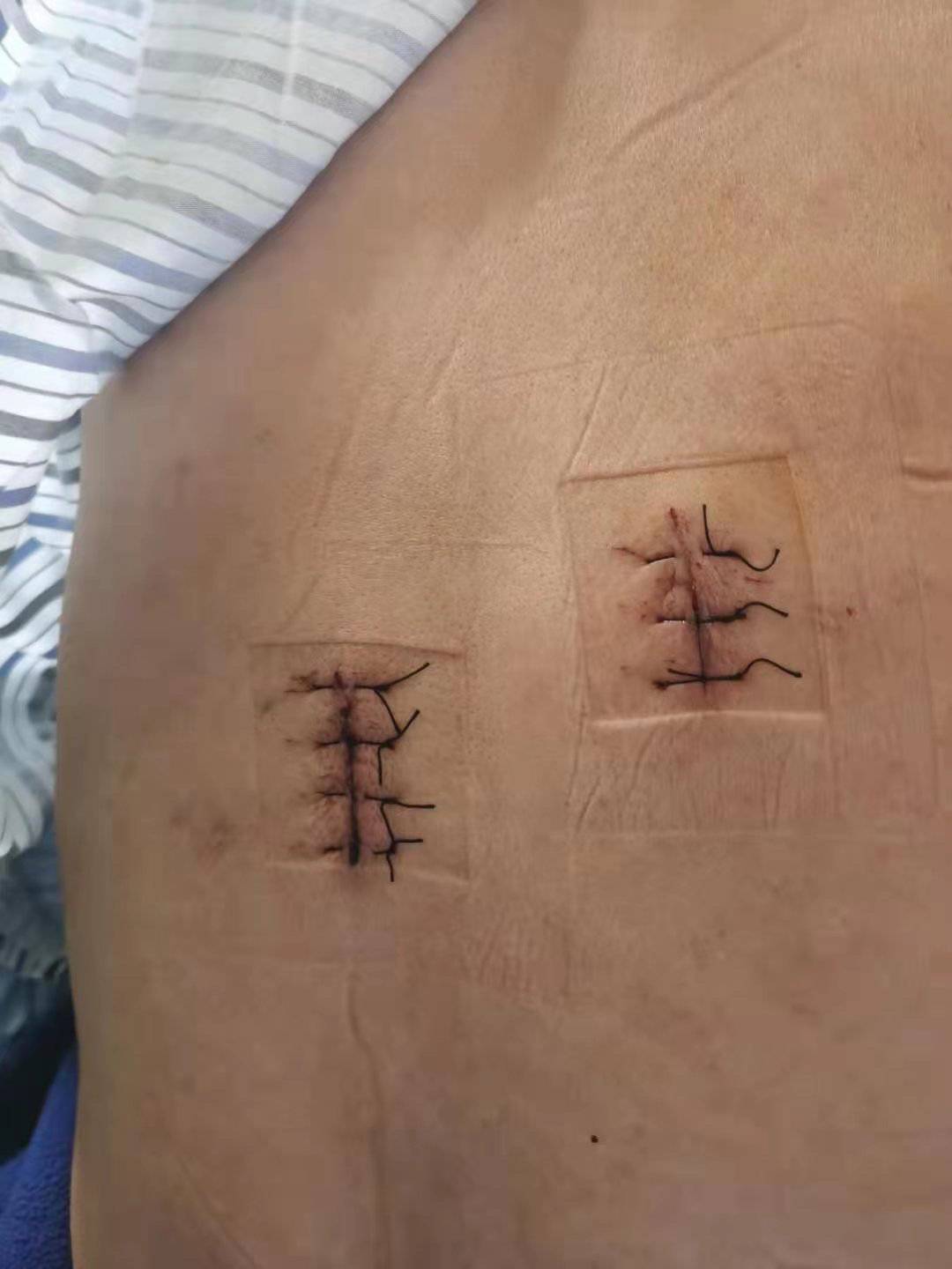 背部手术切口方向图片图片